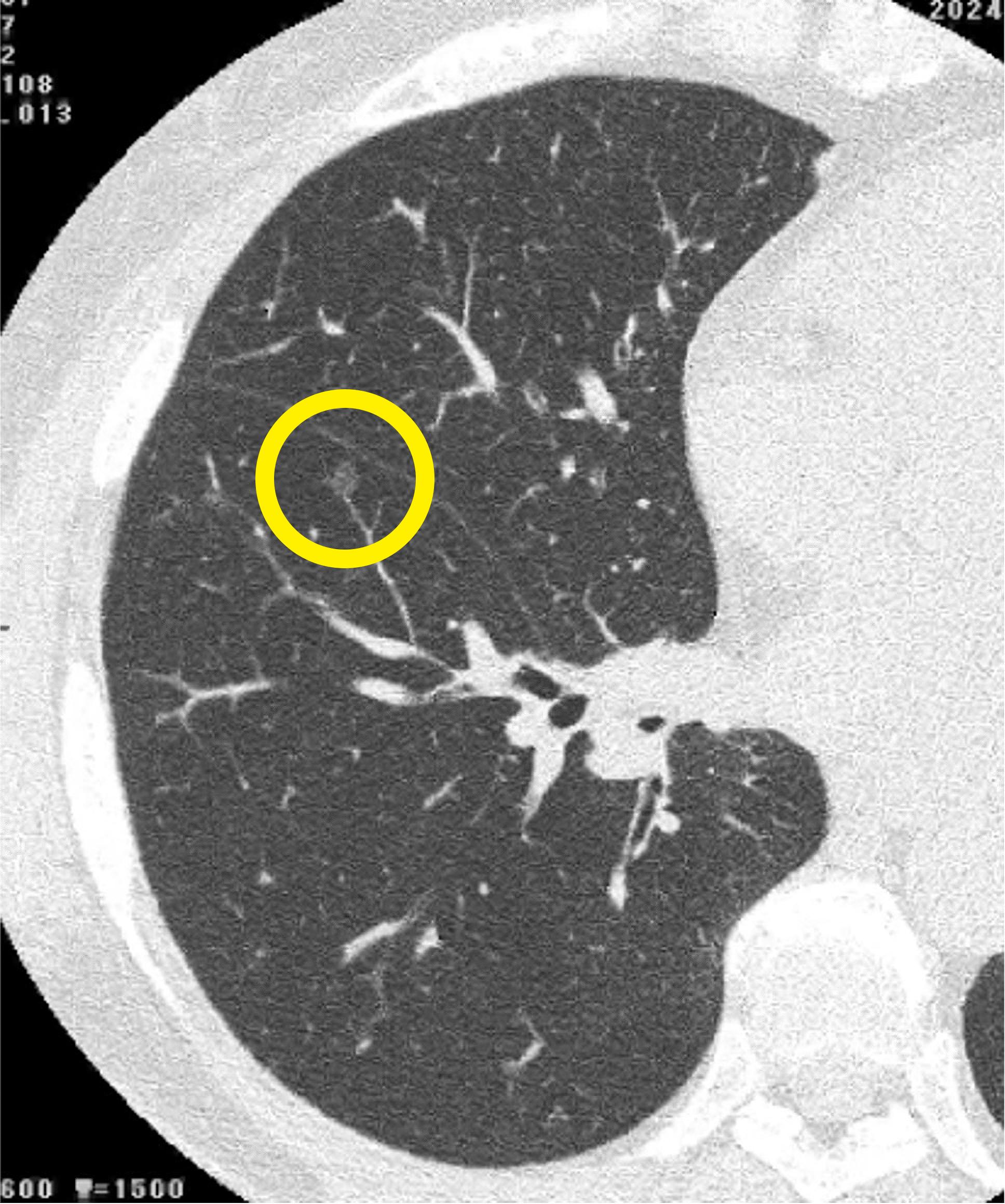 stage0肺がんCT画像