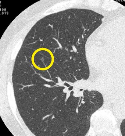 stage0肺がんCT画像